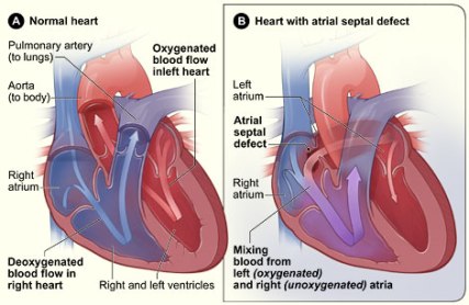 Atrialseptaldefect